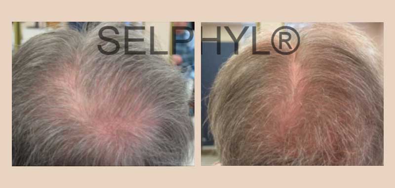 PRP for Hair Loss - before and after garden city